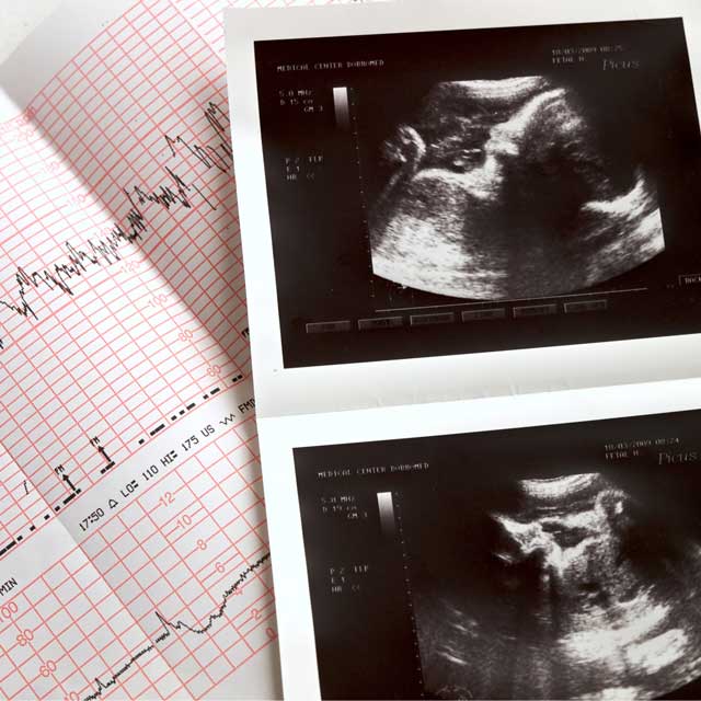 VUMChealth's tweet card. When cared for by the right team, patients with congenital heart disease can have a safe pregnancy. Learn more about planning for pregnancy with CHD.
