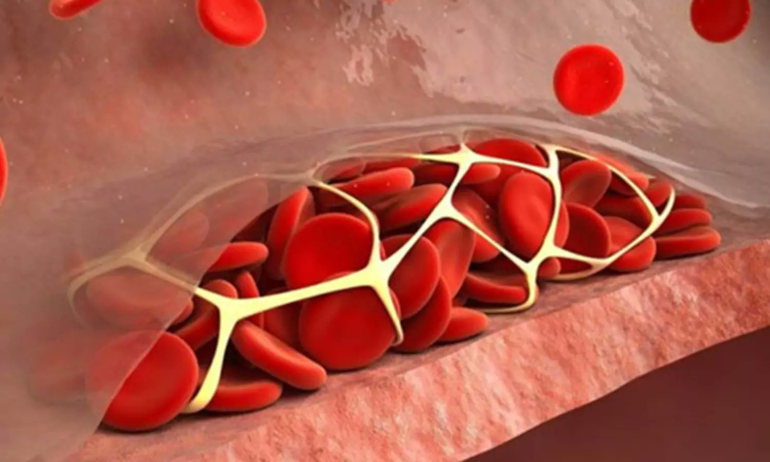 medicaldialogs's tweet card. USA: A recent study found a substantial reluctance by primary clinical teams to initiate thrombop