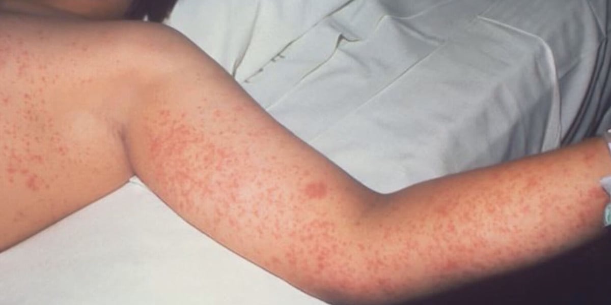 wcax's tweet card. Health officials in South Carolina are reporting new measles cases amid an ongoing outbreak.