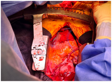 VascularChap's tweet card. Concurrent occurrence of coronary artery disease, aortic valve pathology, and abdominal aortic aneurysm presents a complex challenge for surgical intervention. Traditional staged approach bears...