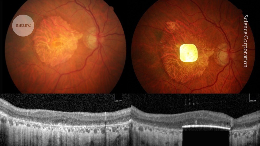 Nature's tweet card. Nature - An electronic eye implant has restored vision in people with blindness caused by age-related macular degeneration.