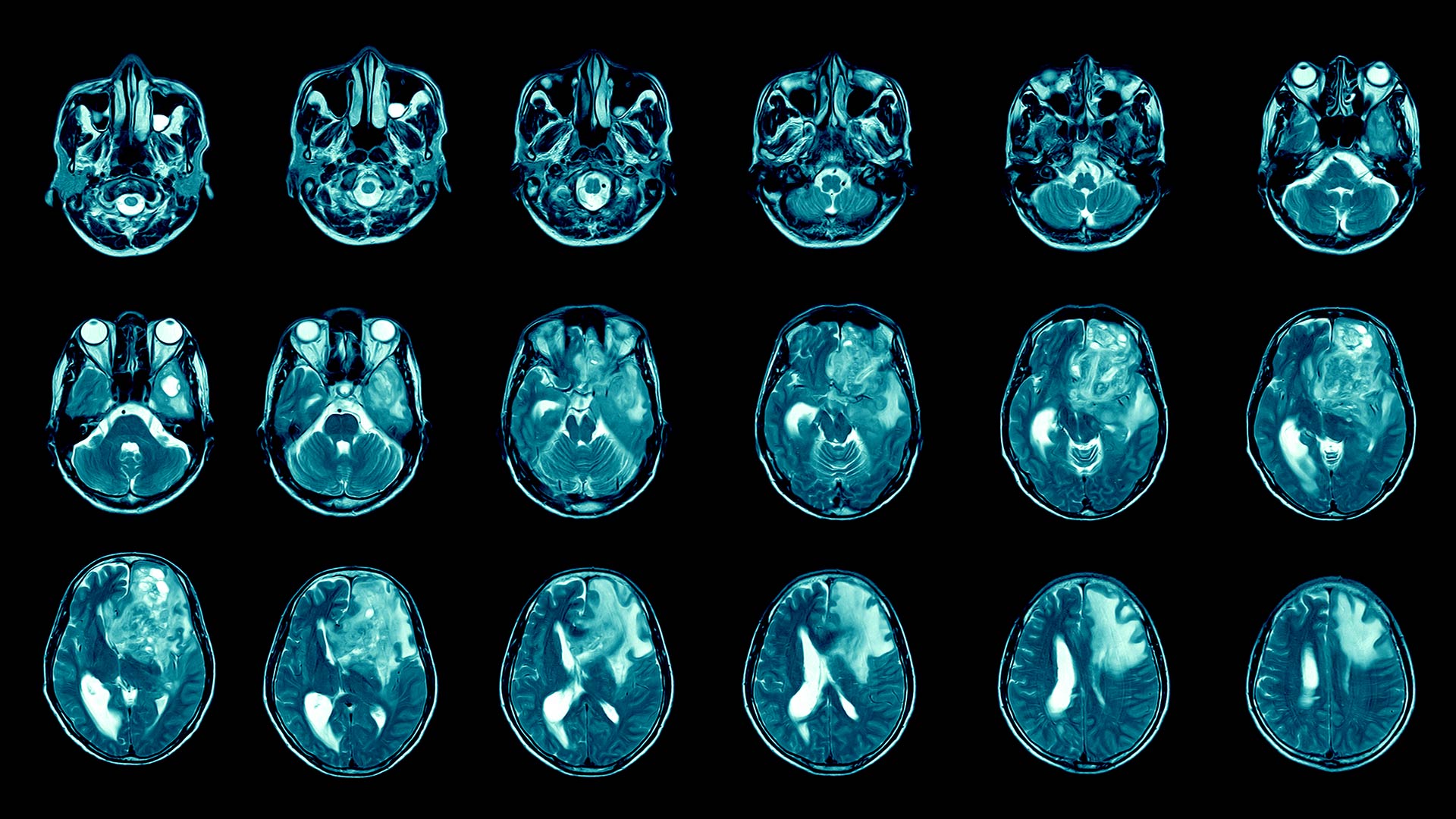NestedKnowledge's tweet card. The brain cancer, glioblastoma, is a fierce and formidable opponent. Its millions of victims include Senator John McCain, President Biden’s son, Beau, and famed film critic Gene Siskel, to name just...