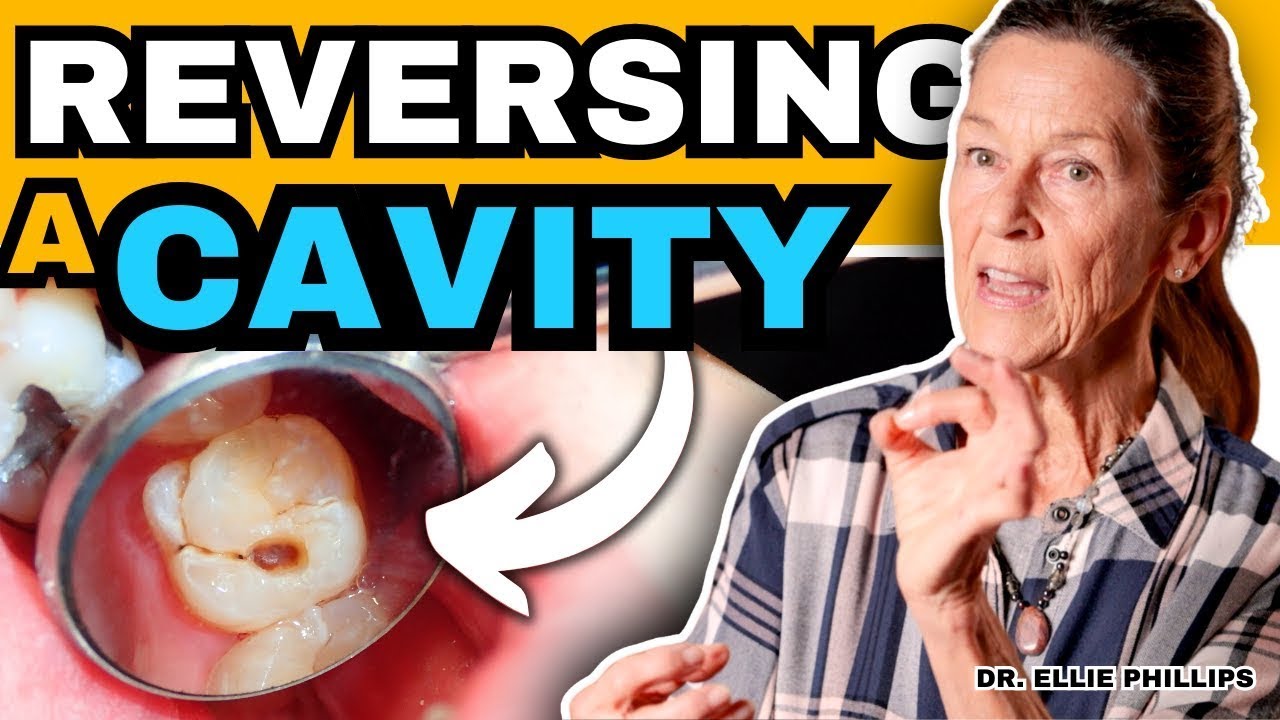 dialogcat's tweet card. How To Reverse a Cavity at Home | Cure Tooth Decay