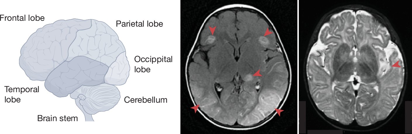 ShenYingZhang1's tweet card. Nature - This article reviews evidence that has emerged over the past two decades indicating that herpes simplex encephalitis in children can result from monogenic defects of brain immunity to...