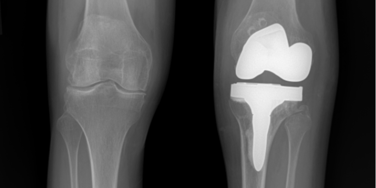 MOR_Docs's tweet card. After years of JIA, Kelly became pain free through same day hip and knee replacements by Dr. Denis Nam at Midwest Orthopaedics at Rush in Chicago