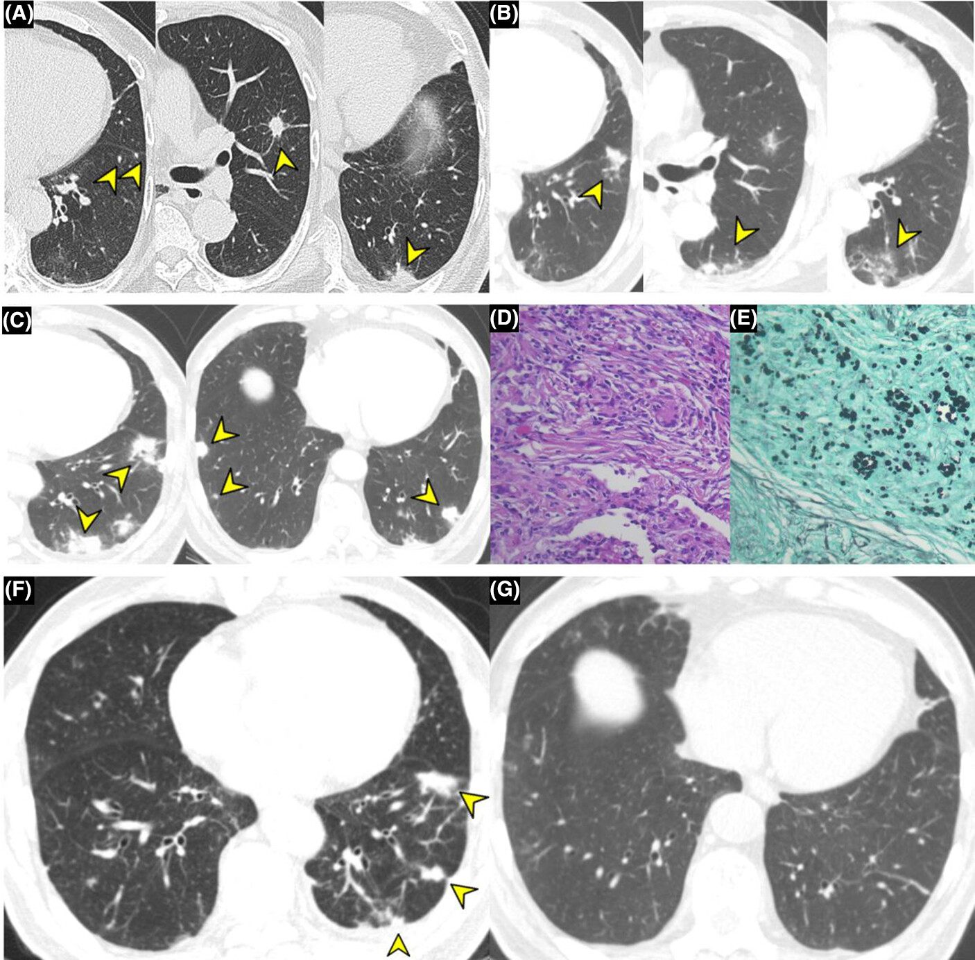 RespirologyAPSR's tweet card. To our knowledge, this is the first case ever reported in the English literature of pulmonary paragonimiasis accompanied by cryptococcal pneumonia.