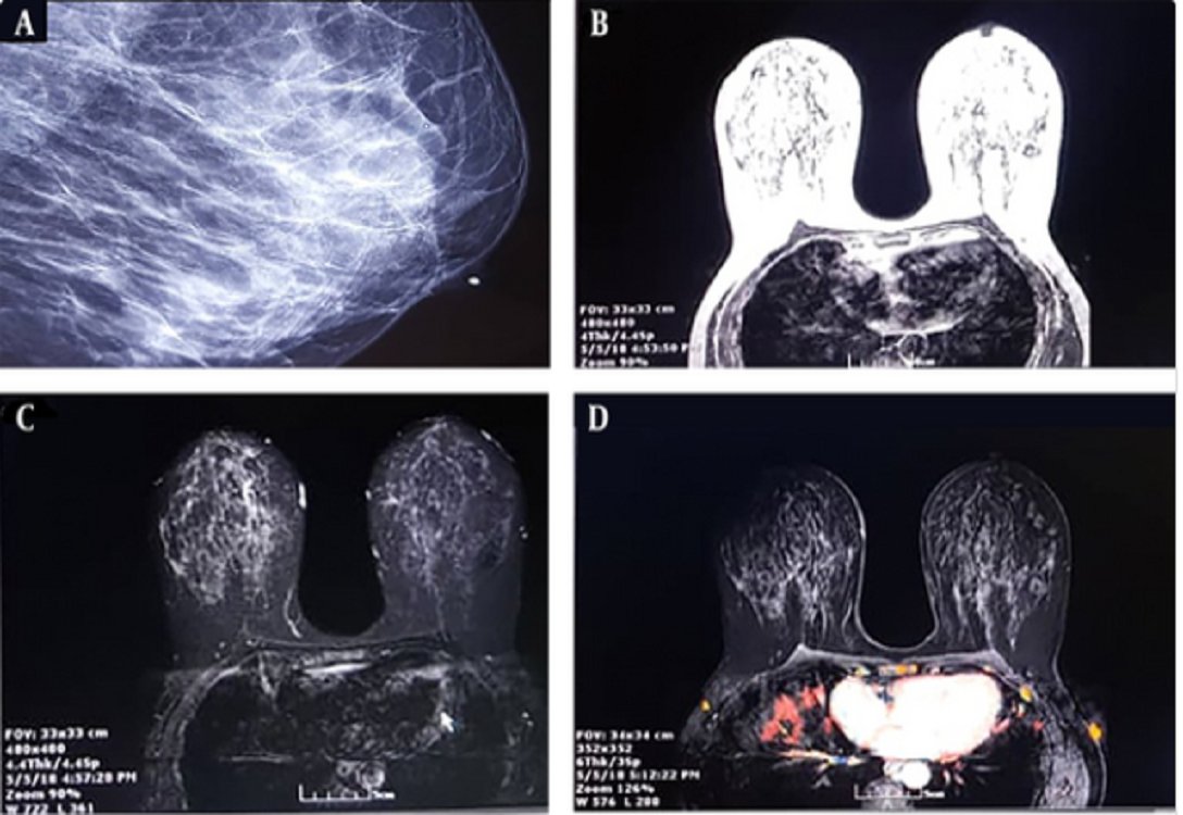 BriefLands's tweet card. Mammograms often reveal breast microcalcifications, necessitating invasive procedures to ascertain whether they are cancerous or benign. ...