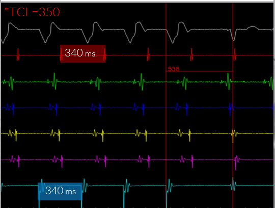 ChartAcademy's tweet card. This course is designed to help you make the connections between induction and proof of diagnosis for supraventricular tachycardia (SVT). Join CHART for an interactive diagnostic pacing course for EP...