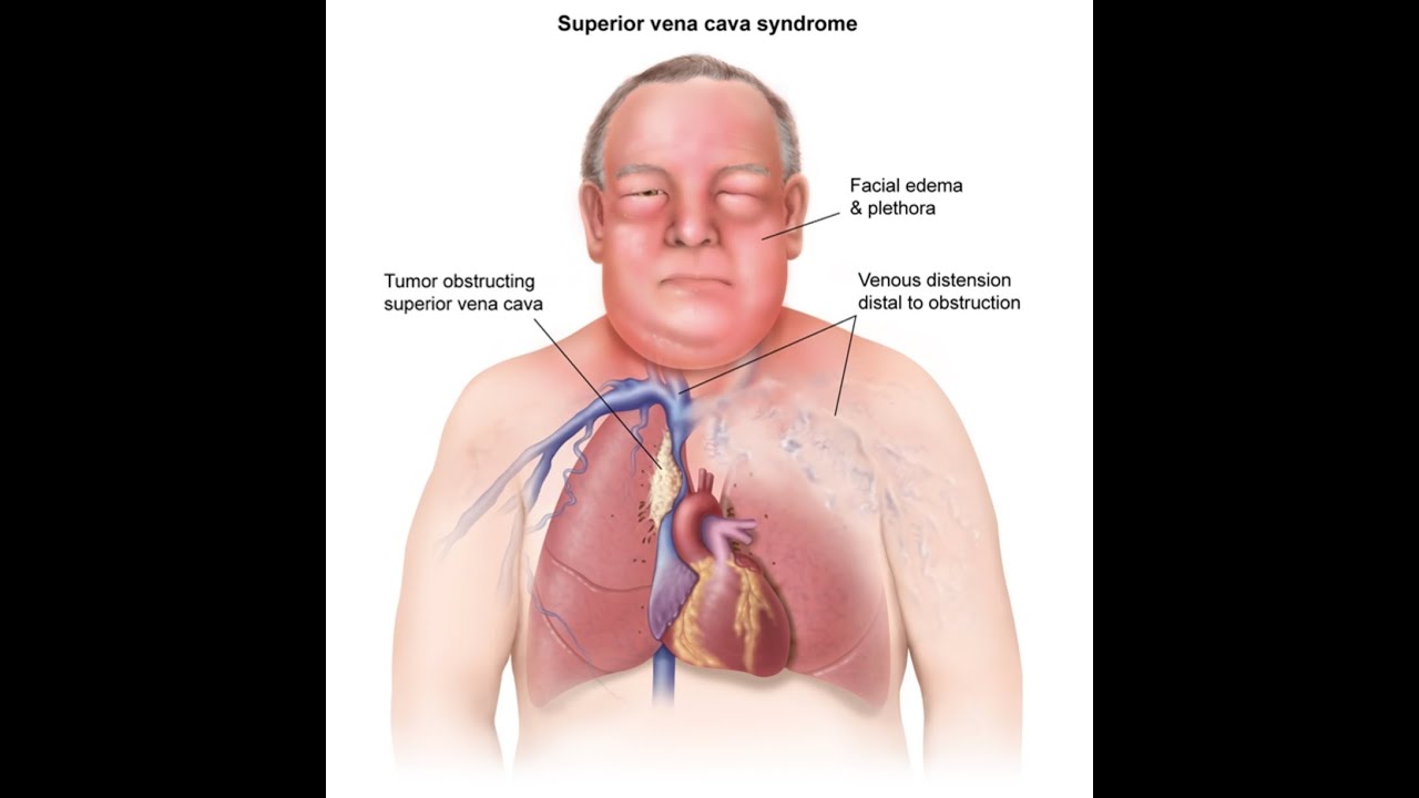megrenalkhayatt's tweet card. SVC syndrome
