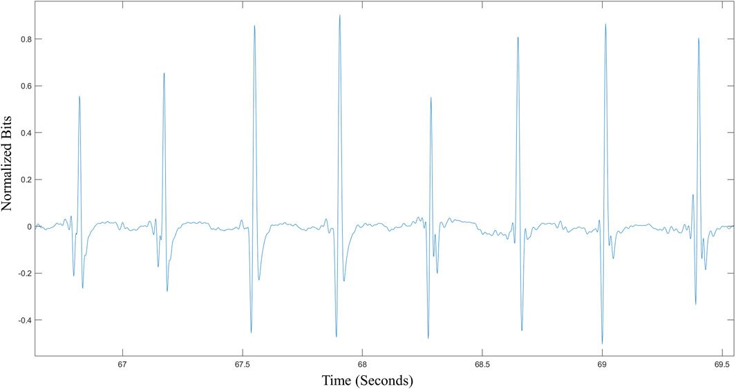 FrontSignalPro's tweet card. Neonatal electrocardiogram (ECG) monitoring is an important diagnostic tool for identifying cardiac issues in infants at birth. Long-term remote neonatal dry...