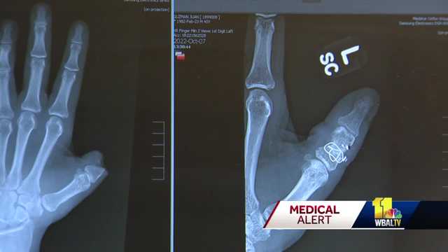 Shalgian's tweet card. A Maryland man who lost his thumb in a dog bite and never thought he'd get his dexterity back is recovering thanks to doctors in Baltimore.