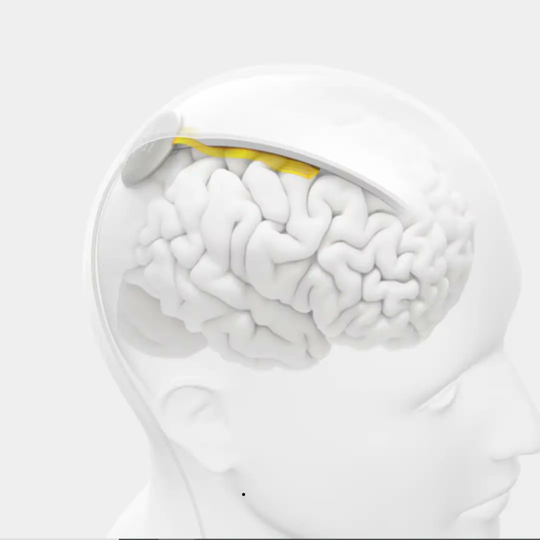 GuidedSolutions's tweet card. Medical Device News by Guided Solutions | Brain-computer interface (BCI) company Precision Neuroscience has received an investment from SCI Ventures, a VC firm that claims to hold the world’s