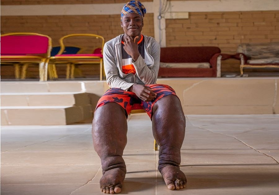 julian_eaton's tweet card. ​​Since the earliest references to what are now termed Neglected Tropical Diseases, the human suffering and social exclusion associated with them has been noted. However, formal research is needed to