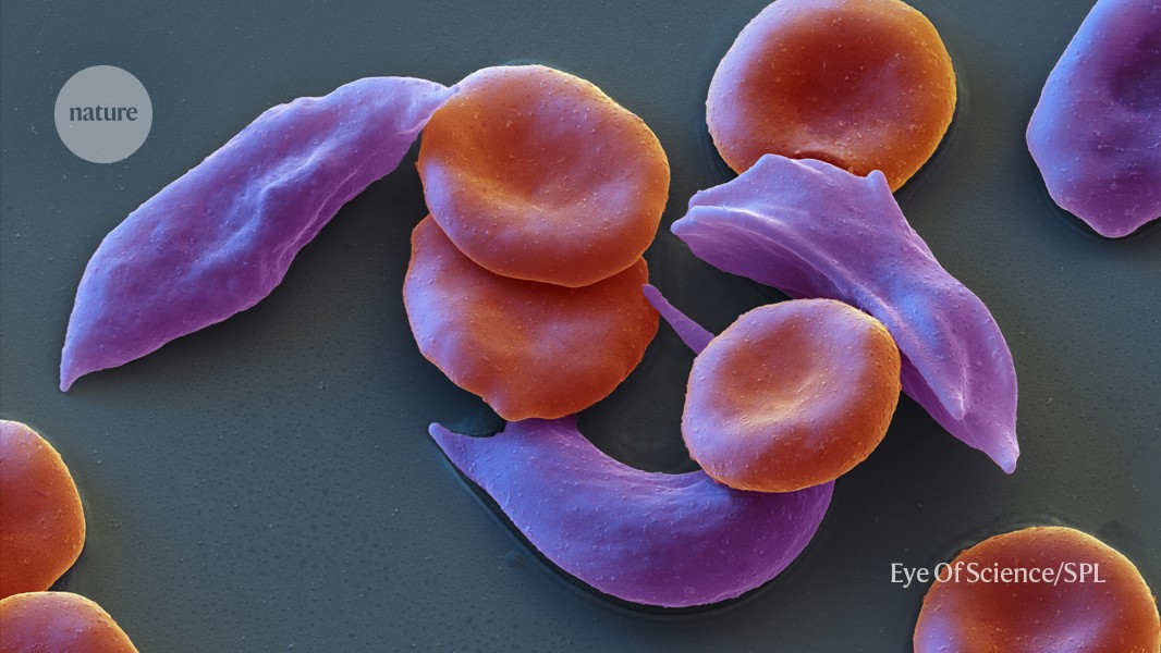 Nature's tweet card. Nature - The landmark decision could transform the treatment of sickle-cell disease and β-thalassaemia — but the technology is expensive.