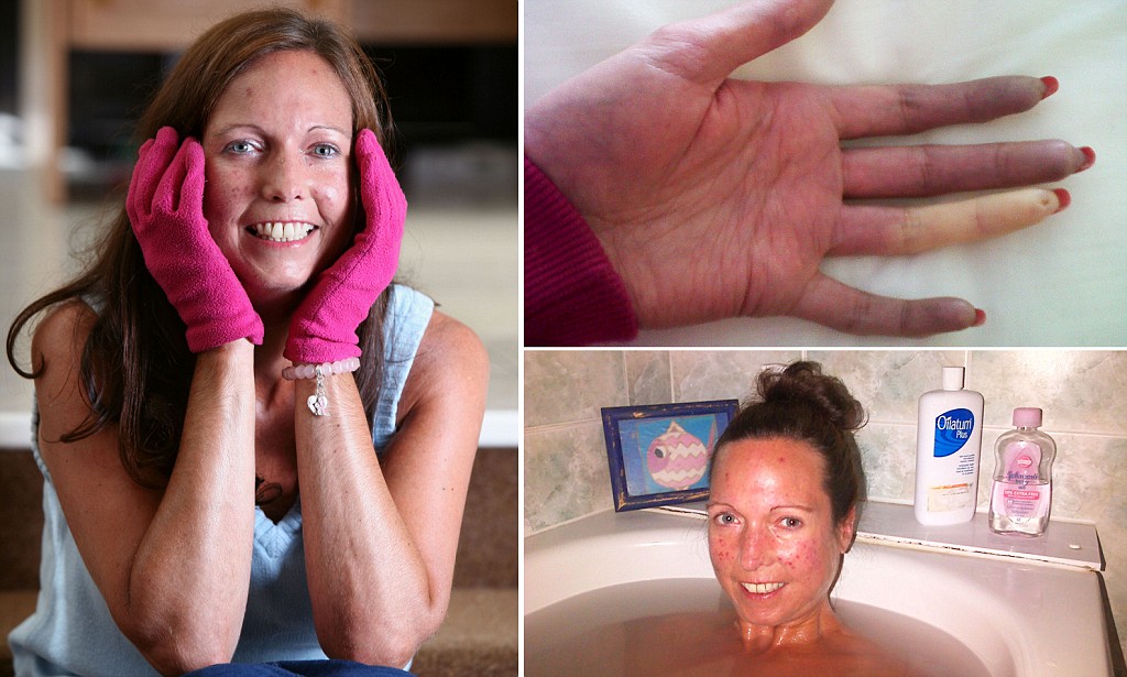 cosmicfairy444's tweet card. Nicola Whitehill, 40, of Southport, Merseyside, has systemic sclerosis (scleroderma), meaning her skin and blood vessels harden and restrict her movement.