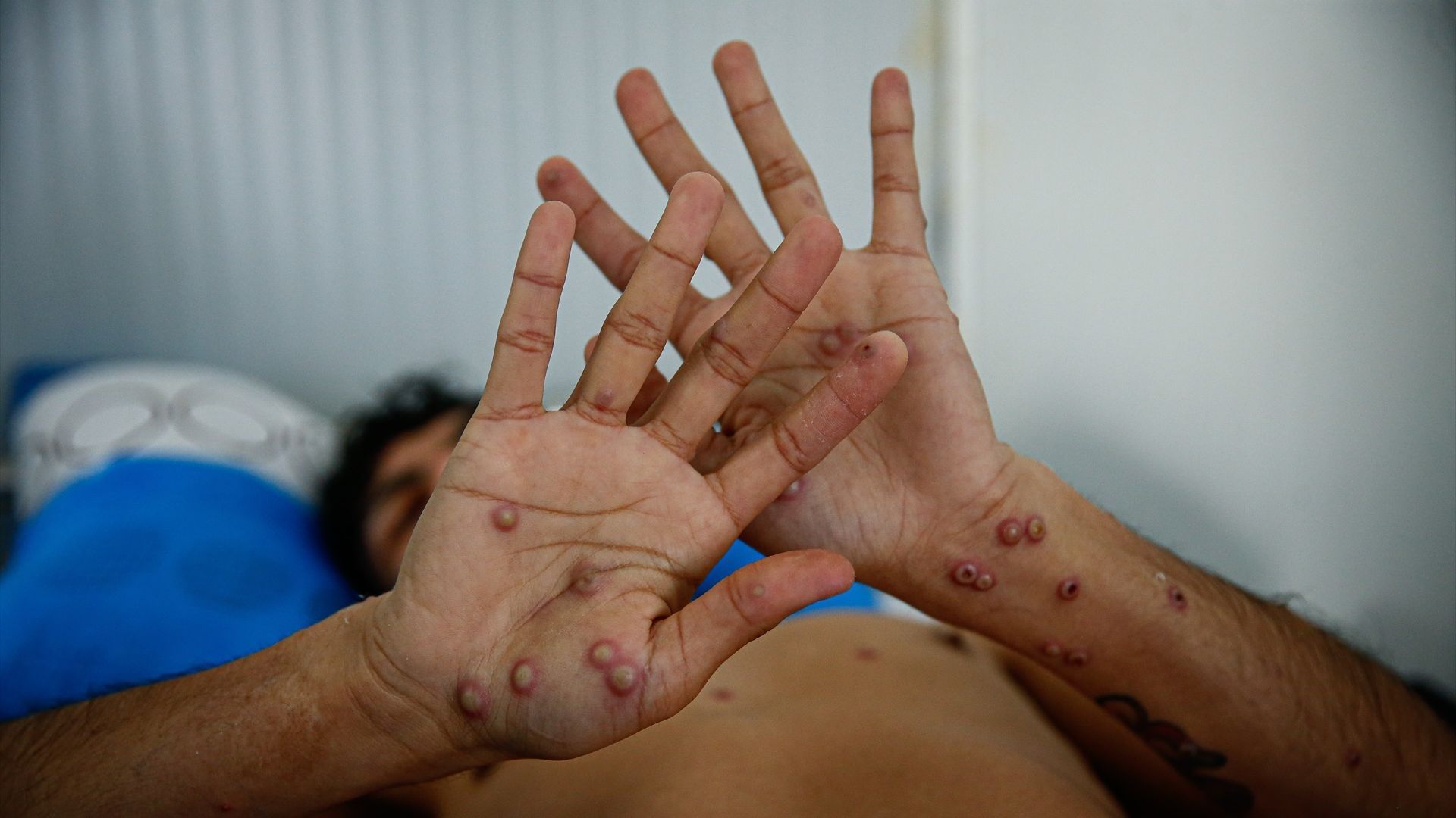 telecincoes's tweet card. La preocupación por la nueva expansión del virus mpox , antes denominado viruela del mono , continúa extendiéndose y los distintos países y organism