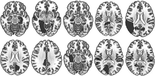 AeroMedicine's tweet card. Abstract. There is disagreement regarding the major components of the brain network supporting spatial cognition. To address this issue, we applied a lesio