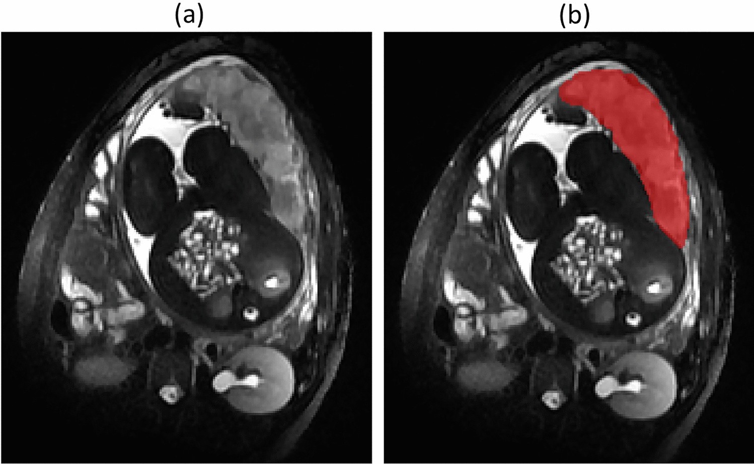 DevBrainLab's tweet card. Scientific Reports - Influence of maternal psychological distress during COVID-19 pandemic on placental morphometry and texture