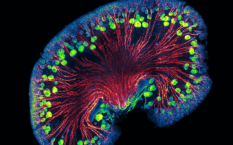uclnews's tweet card. Focusing on rare conditions could significantly reduce the burden of kidney disease on both patients and the NHS, according to a major new study led by UCL and the UK Kidney Association.