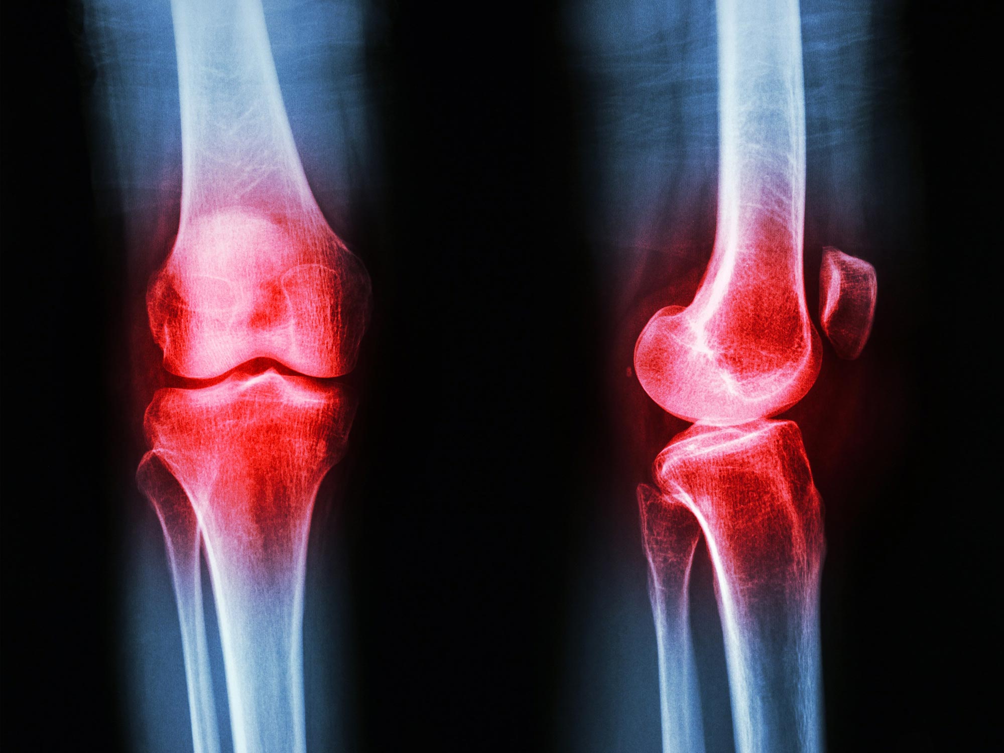 PHD2468's tweet card. A new study led by a Utah engineering professor shows that gait retraining can reduce pain and slow cartilage damage. Almost one in four adults over the age of 40 live with painful osteoarthritis, a...