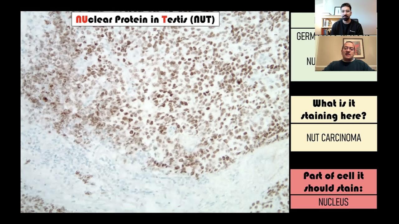 smlungpathguy's tweet card. Immunohistochemistry in Pathology