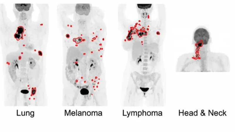 RadiologiaLatam's tweet card. el deep transfer learning está mejorando la detección y evaluación de riesgo de múltiples cánceres en PET/CT corporal total