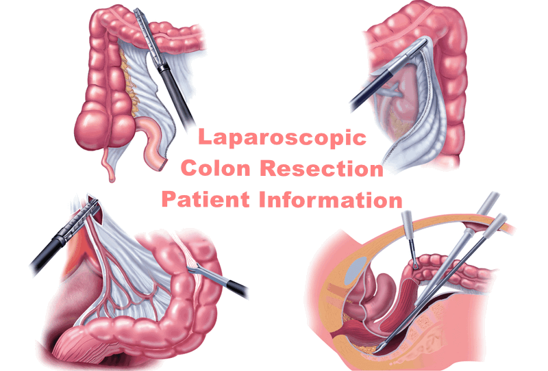 digiwibes's tweet card. The inflammatory bowel disease Crohn's disease is treated with small intestine resection surgery. For Appointment: +1 (817) 748-0200.