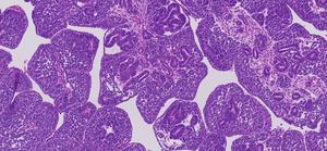 GlobalGenMed's tweet card. By harnessing the latest genomic sequencing technology, researchers reveal hidden mutations in childhood kidney cancer, Wilms tumour. 