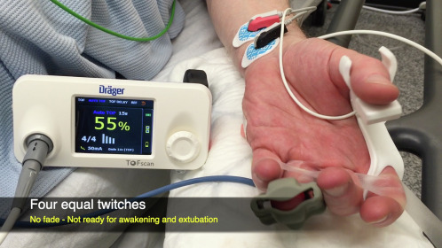 BJAJournals's tweet card. Monitoring and reversal of neuromuscular block have been reviewed extensively, including in this journal.1,2 Issues with management of neuromuscular block (NMB) and residual block persist, despite...