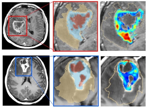 bcawareness's tweet card. Computational analysis of MRI scans from glioblastoma patients may help predict survival and response to treatments