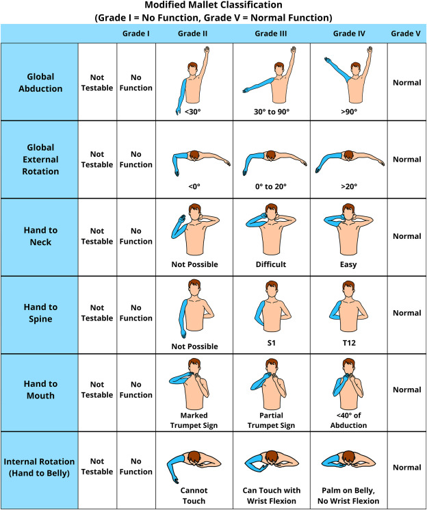 JHandSurg's tweet card. In brachial plexus birth injury (BPBI), children with upper trunk injuries have multidirectional movement deficits, including global abduction and hand-to-neck, hand-to-abdomen, and hand-to-spine...