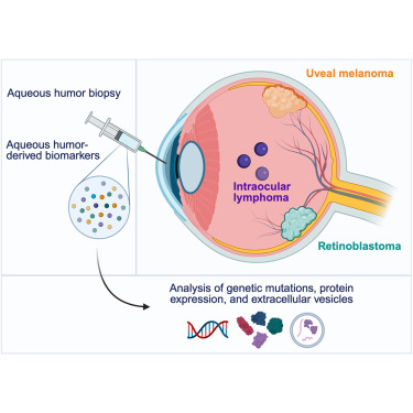 CellRepMed's tweet card. Recent advances in aqueous humor-derived oncologic biomarkers have opened the door to using liquid biopsy to detect and monitor ocular cancers. This review by Cheslow et al. details relevant and...