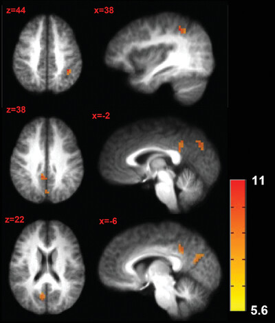 neural_Tim's tweet card. Neural correlates of shared resources between pain and cognition were demonstrated in the precuneus, cingulate gyrus, and inferior parietal lobule. There were no significant effects of interactions...