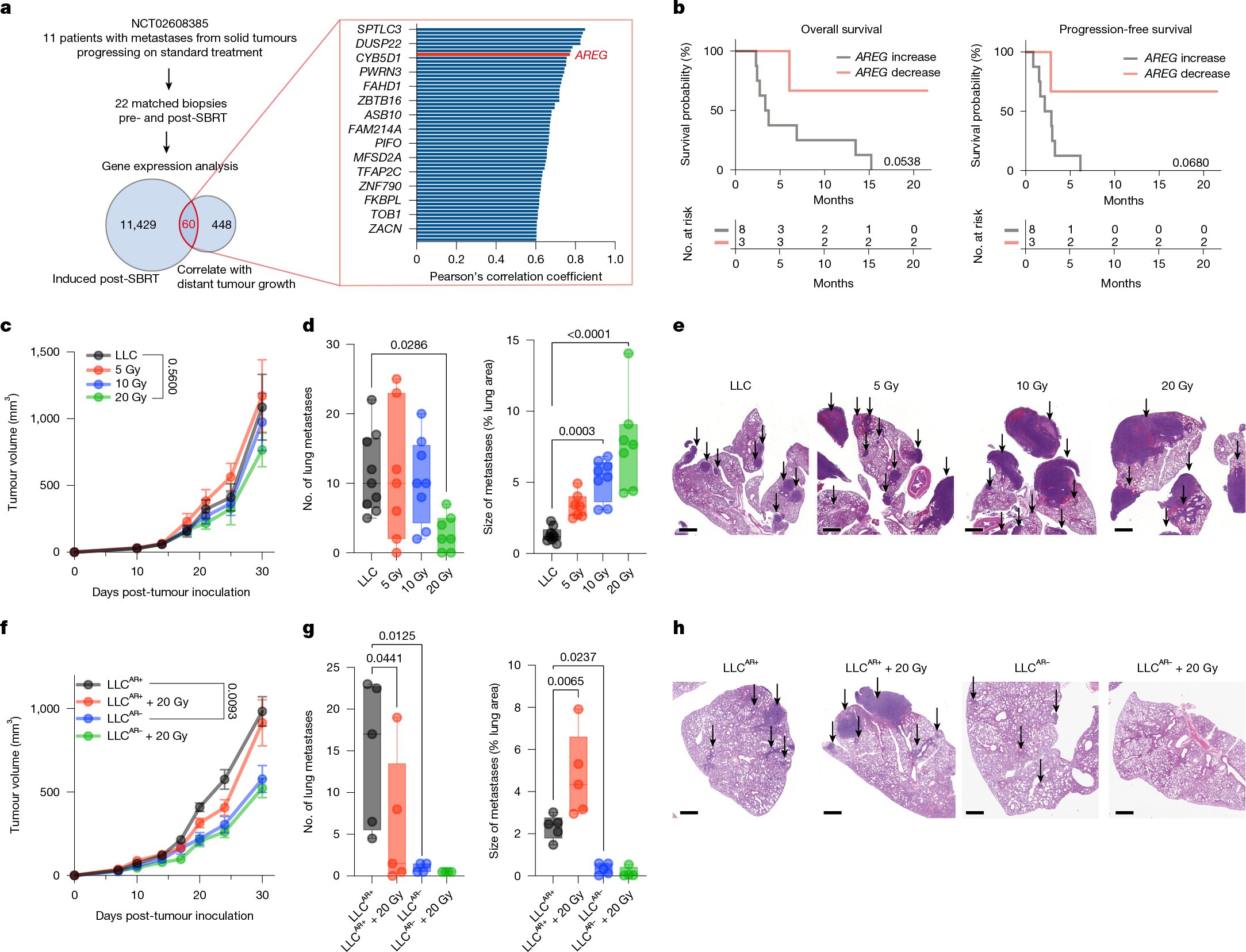 dbalci's tweet card. Nature - Radiotherapy induces expression of the EGFR ligand amphiregulin, which promotes metastasis growth at remote sites in mouse models and human patients by shifting myeloid cells towards an...