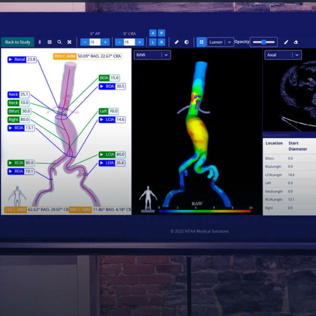 GuidedSolutions's tweet card. Medical Device News by Guided Solutions | ViTAA Medical’s aortic surgery planning tool has gained clearance from the US Food and Drug Administration (FDA), representing the first milestone in the