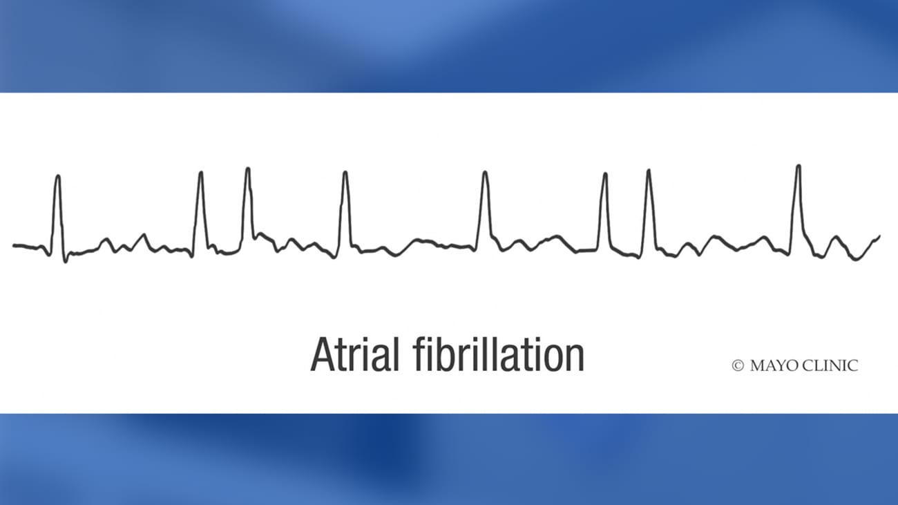 abhishek_mbbs's tweet card. Review atrial fibrillation best practices in this Grand Rounds video for clinicians.