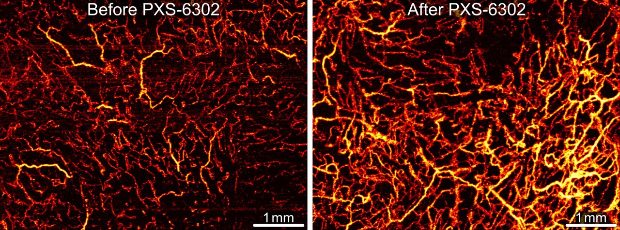 medical_xpress's tweet card. University of Western Australia's Burn Injury Research Unit with the Fiona Wood Foundation reports that topical pan-lysyl oxidase inhibition with PXS-6302 was generally well tolerated over three...