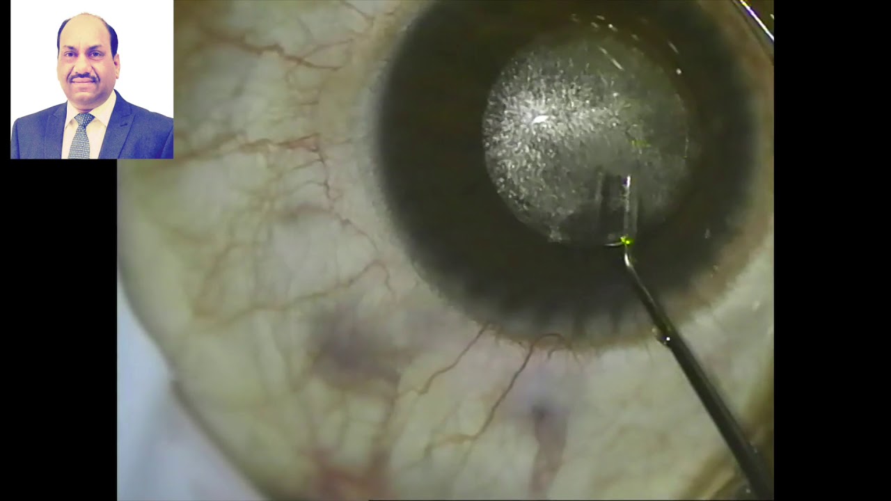 DRVLPSC_eye's tweet card. ReLEx SMILE New hydroexpression Technique for lenticule removal.