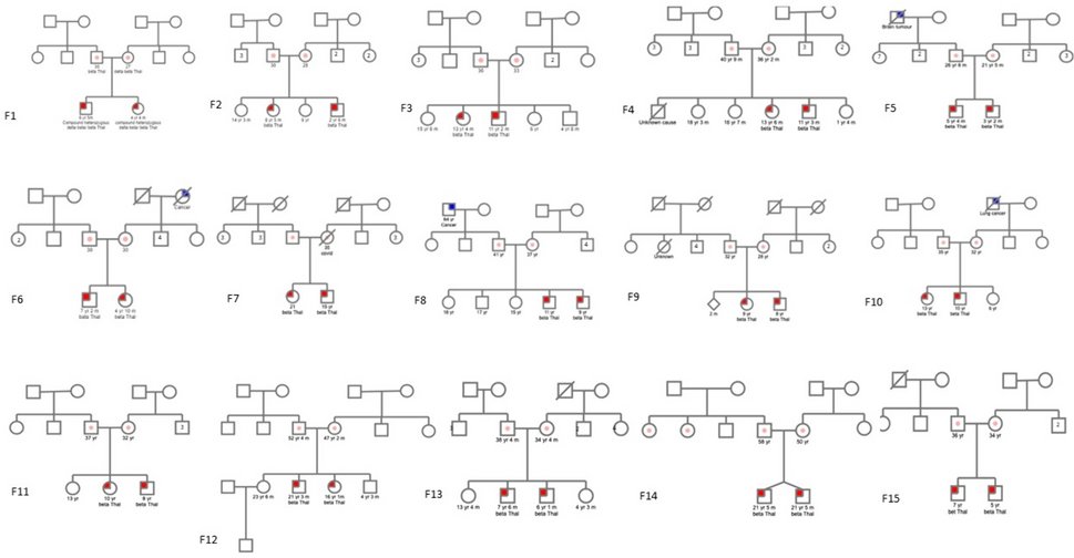 Drdolatsingh's tweet card. Indian Journal of Hematology and Blood Transfusion - The transfusion-dependent form of thalassemia (TDT) presents as a challenging clinical scenario, requiring life-long care and monitoring....