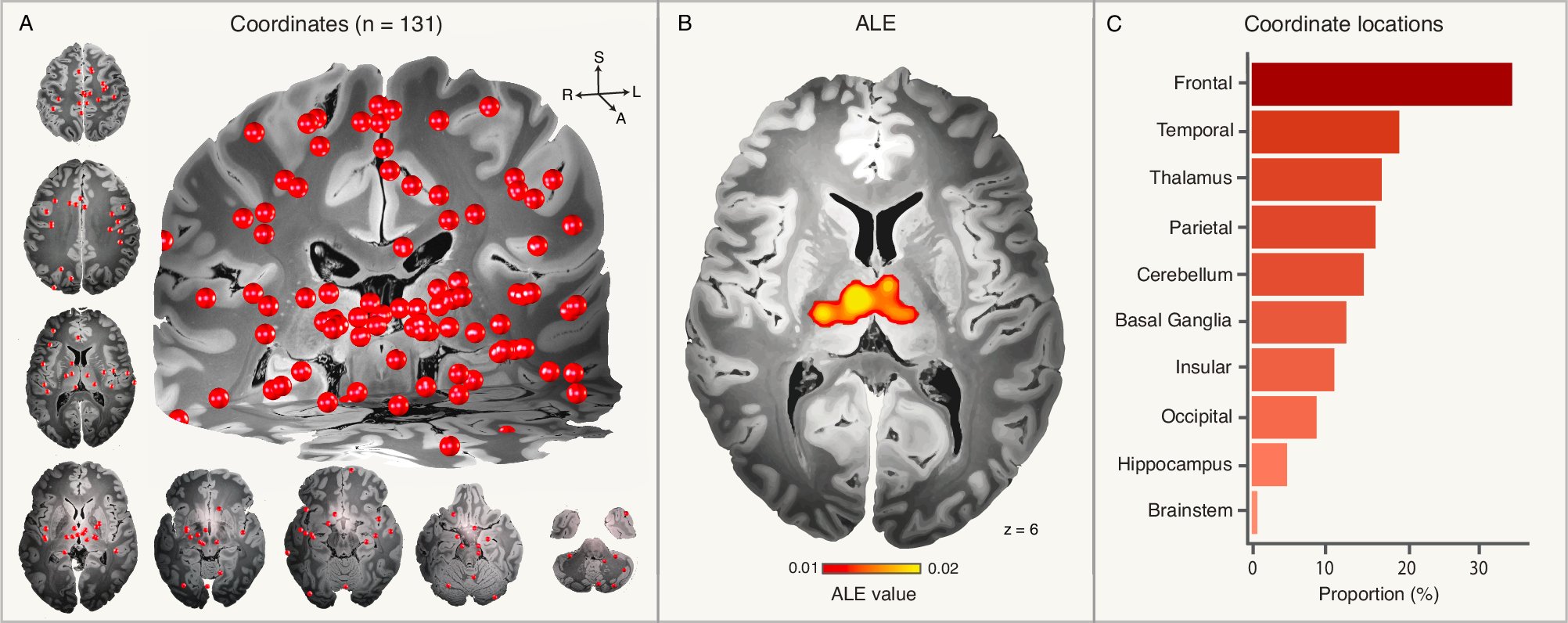 fredschaper_'s tweet card. Nature Communications - Ji et al. identify an idiopathic generalised epilepsy network that links heterogeneously distributed brain abnormalities to a common brain network and deep brain stimulation...