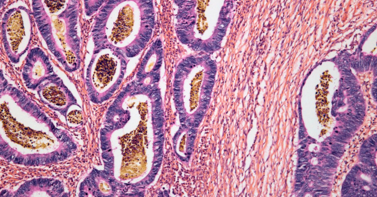 DrDanaFlavin's tweet card. Several types of cancer appear to respond to an immune-based treatment.