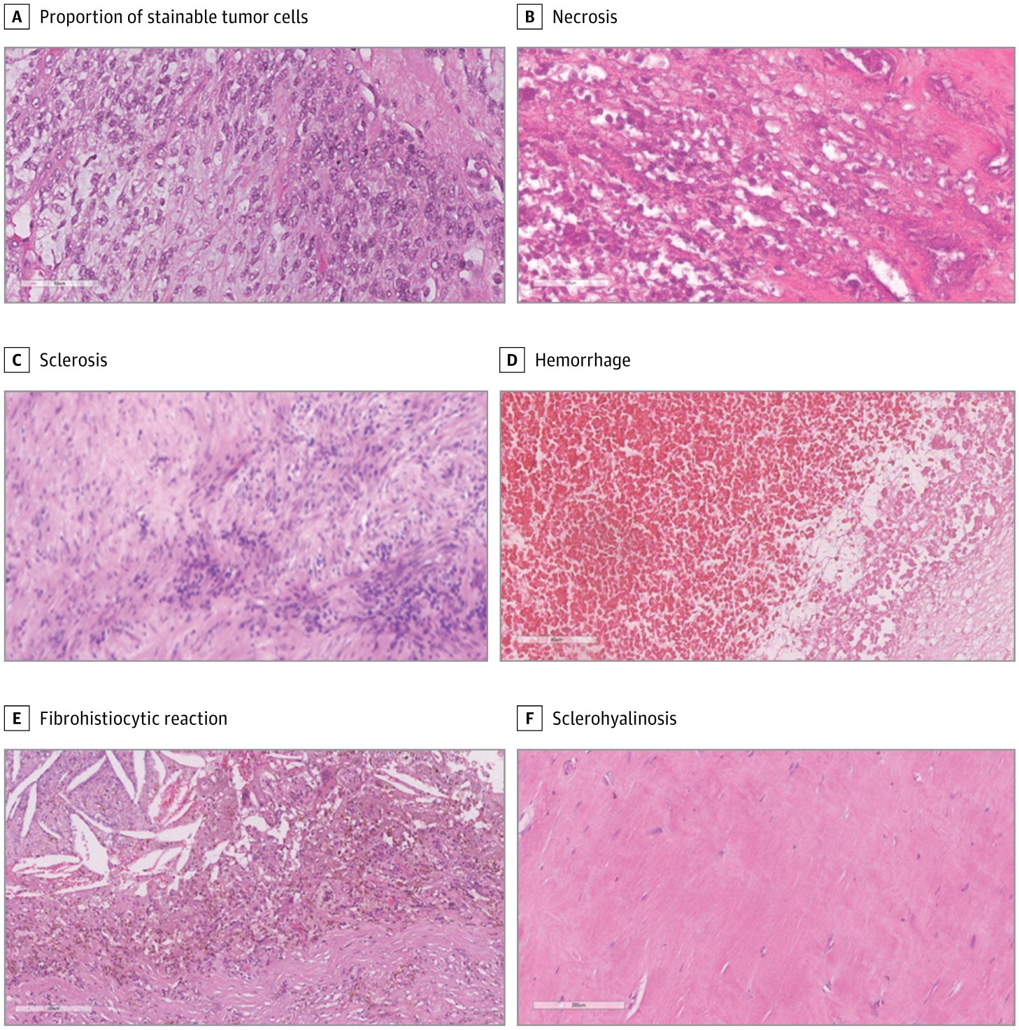 BibliotecaHUVH's tweet card. This secondary analysis of a randomized clinical trial evaluates the histopathological features associated with risk of recurrence that can be used to estimate outcomes in patients with high-risk...