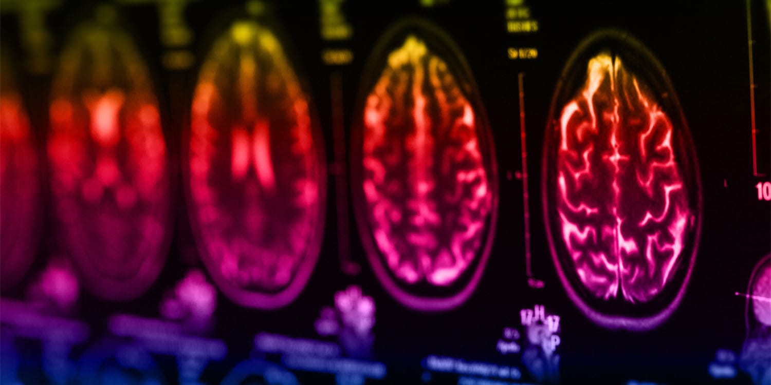 PsyPost's tweet card. A new study in Advanced Science reveals the brain uses two parallel networks to recognize familiar sounds. One network processes the sound itself, while a second, deeper network compares it to memory...