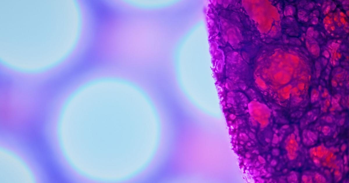 UniOulu's tweet card. Human papillomavirus (HPV) type replacement occurs: as HPV vaccination reduces the number of carcinogenic HPV types in a population, previously rare, less harmful HPV types appear to occupy this...