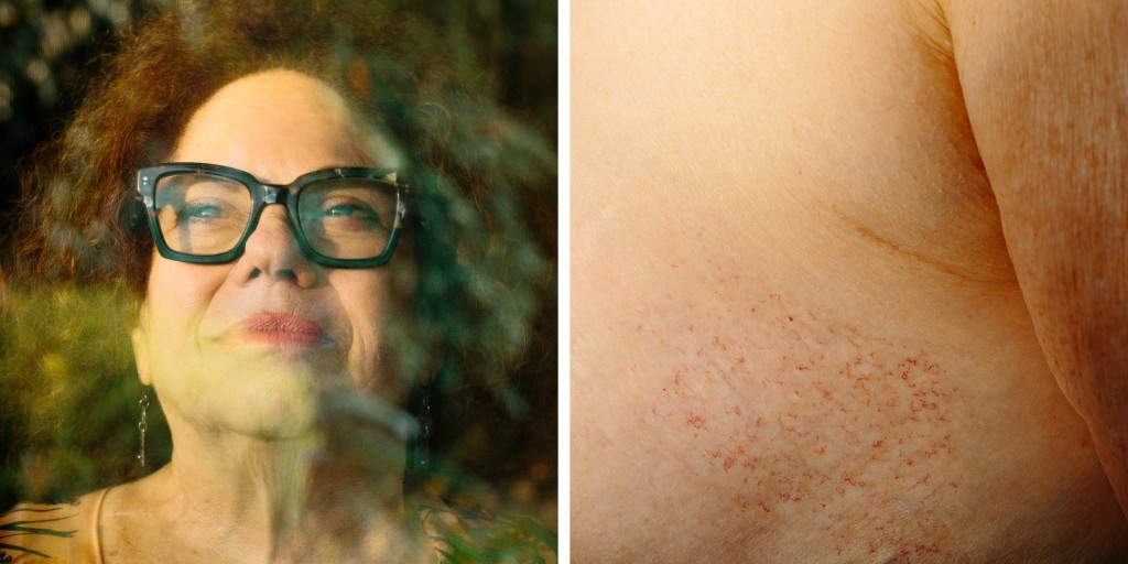 gmorgenson's tweet card. The technique, known as IORT, has numerous benefits, surgeons say, but it generates less money for hospitals and radiation oncologists.