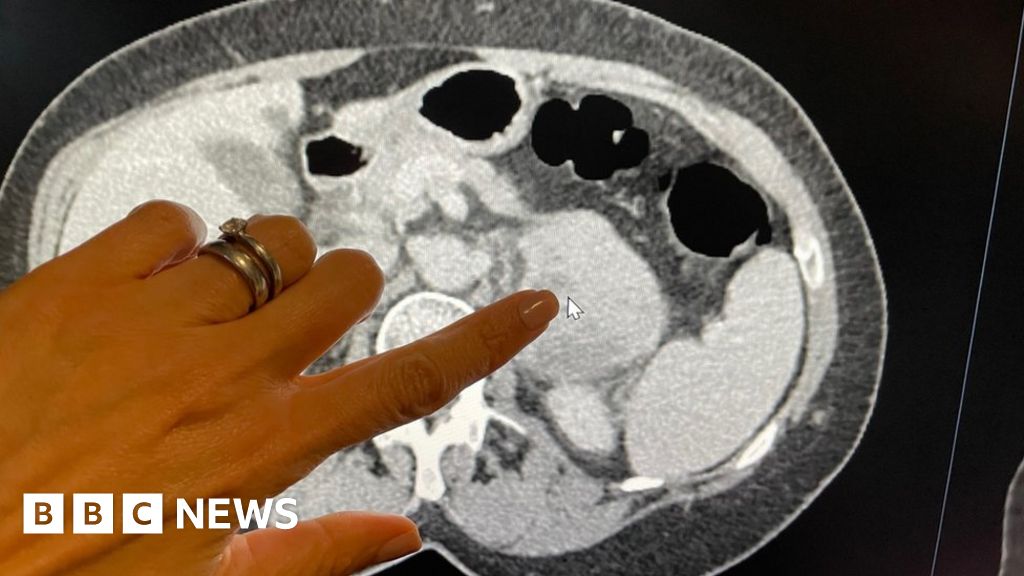 BBCNews's tweet card. AI is twice as good at grading the aggressiveness of tumours than lab analysis, a study suggests.