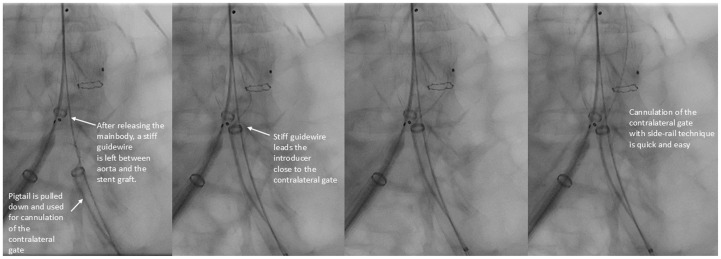 JVascSurgCIT's tweet card. In challenging anatomy and large aneurysms, cannulation of the contralateral gate may be time-consuming and sometimes requires crossover approach with a snare. At Helsinki University Hospital, we...