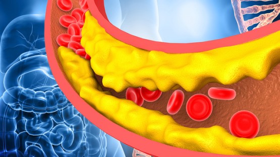 weillinstitute's tweet card. Cornell researchers have uncovered the surprising role played by a “three-tailed” fat molecule in cellular survival during heart attack and stroke: protecting the cells against damage when oxygen...