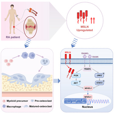 CellRepMed's tweet card. Su et al. reveal that MSLN is significantly upregulated in RA patients and CIA animal models, where it drives osteoclast differentiation via the PI3K/AKT signaling. Inhibition of MSLN attenuates bone...
