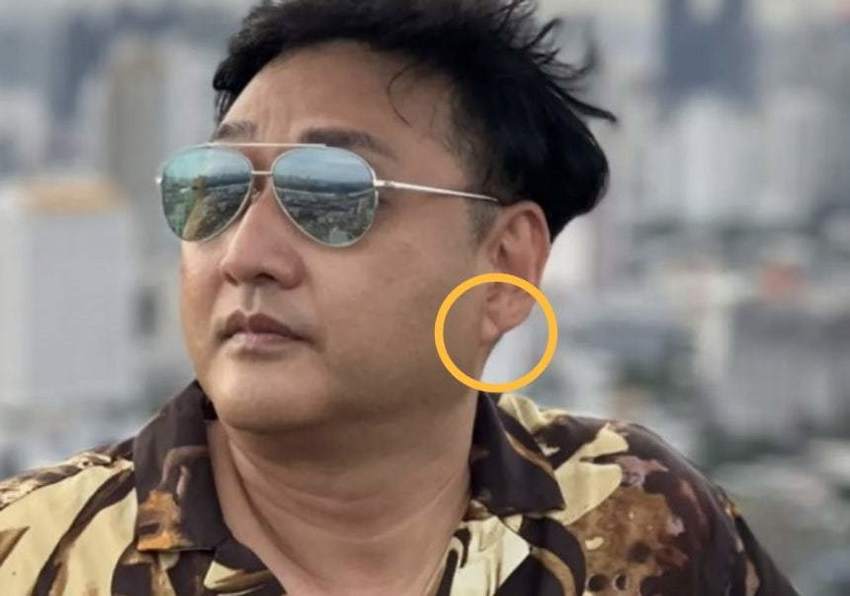 SBSBiznews's tweet card. 방송인 김수용이 촬영 중 의식을 잃고 쓰러져 치료를 받았다는 소식이 전해진 후, 그의 귓볼에서 전조 증상을 발견했다는 반응들이 나오고 있습니다. 김수용의 귓볼의 대각선 주름이 심혈관 질환과 연관된 '프랭크 징후(Frank's Sign)'일 가능성이 있다는 주장도 제기되고 있습니다.누리꾼이 언급한 ‘프랭크 징후’…